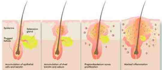 What are the Causes of Acne? What are the Causes of Acne?